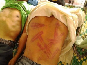 Parishioners show bruises from police beatings during a crackdown on protests in Vietnam's Nghe An province, Sept. 4, 2013. Photo courtesy of Vietnamese Redemptorists News