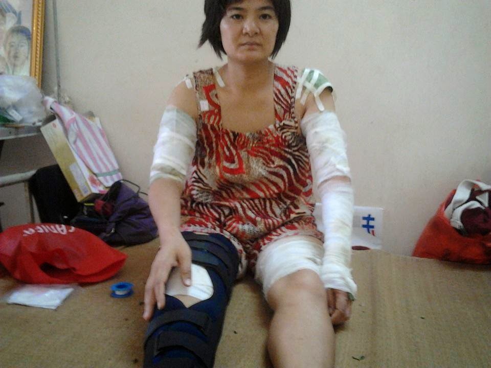 Thuy Nga vet thuong 2